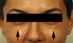 reversal juvederm hyaluronidase before injections celibre