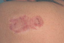 keloid scars treatment after photo