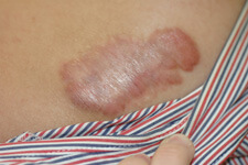 keloid scar treatment before photo
