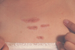 los angeles keloid scar removal with lasers after picture