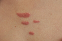 los angeles keloid scar removal with lasers before picture