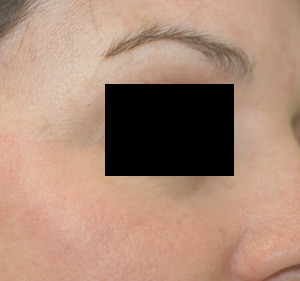 erbium vs. fraxel resurfacing before and after pictures