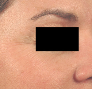 erbium vs. fraxel resurfacing before and after pictures