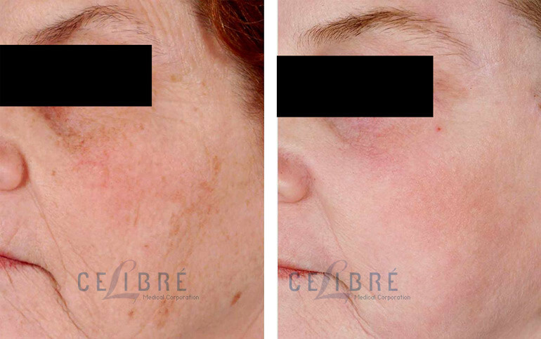 laser resurfacing Options before and after pictures