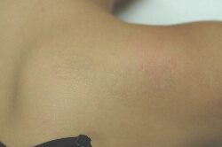 laser tattoo removal costs before and after pictures