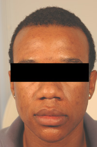 los angeles acne scar removal with lasers before picture