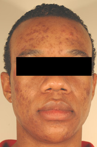 los angeles acne scar removal with lasers before picture