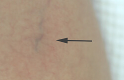 long beach spider vein removal lasers before and after pictures