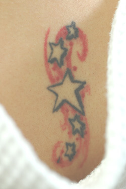 Is Laser Tattoo Removal Permanent  Long Beach Laser Tattoo Removal   Laser Skin Care Center