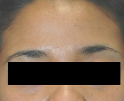 Los Angeles brown acne scar removal before and after pictures