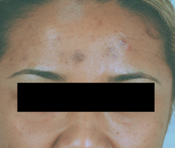 Los Angeles brown acne scar removal before and after pictures