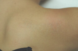 Hypopigmentation after laser treatment burns photo  Tips For Skin Care   Hairtell hair removal forum by Andrea James