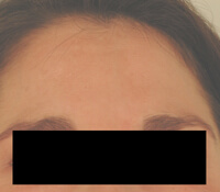 los angeles melasma treatment before and after photos