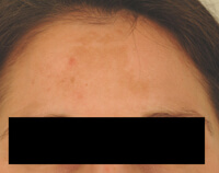 melasma treatment los angeles before and after photos