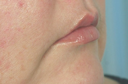 mouth frown revision with restylane before and after pictures