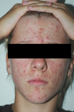 orange county laser acne treatment before and after pictures