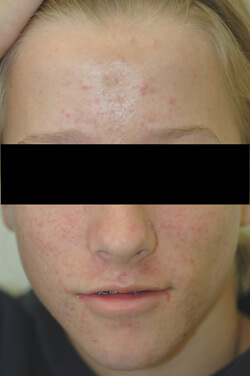 orange county laser acne treatment before and after pictures