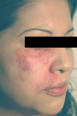 port wine birthmark removal los angeles laser after photo