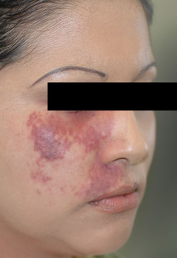 port wine birthmark removal los angeles laser before photo