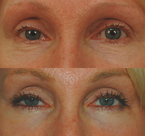 Fractional Laser Resurfacing for Eye Wrinkles