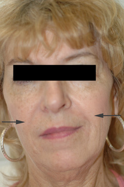 Restylane los angeles after photo