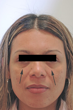 los angeles restylane for dark circles before photo