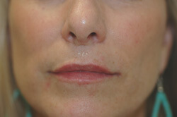 los angeles restylane for lips after photo