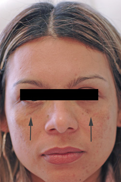 los angeles restylane for dark circles after photo