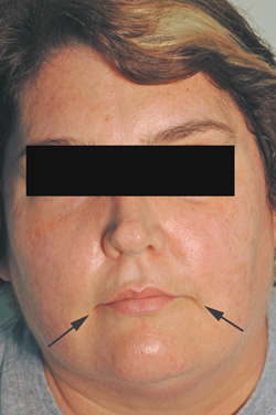 Los Angeles Botox injections after picture