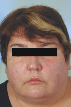 Los Angeles Botox injections before picture