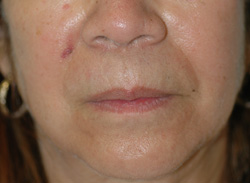 Restylane and Juvederm Injections picture