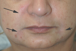 downtime for restylane injections before and after pictures