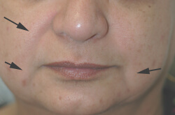 downtime for restylane injections before and after pictures