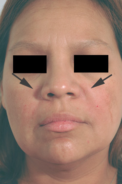los angeles restylane for laugh lines before and after pictures