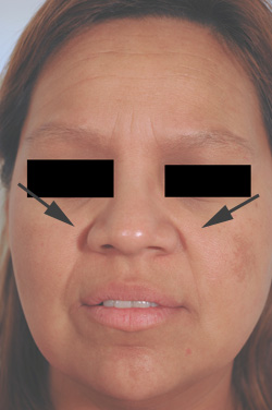 los angeles restylane for laugh lines before and after pictures