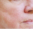 los angeles laser rosacea treatment before and after photos