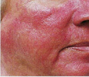 los angeles laser rosacea treatment before and after photos