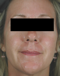 los angeles rosacea laser treatment before and after photos