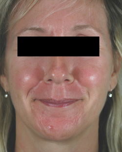 los angeles rosacea laser treatment before and after photos