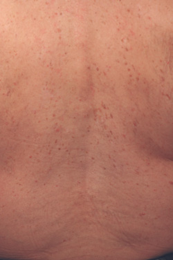 laser treatments for age spots after picture