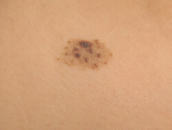 brown birthmarks