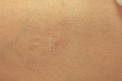 What Are Spider Veins & removal before and after pictures