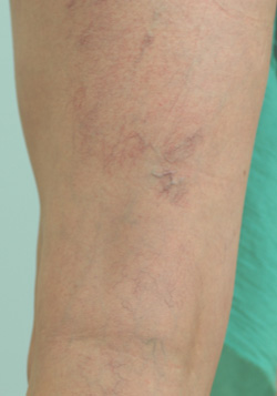 los angeles spider vein removal before and after pictures