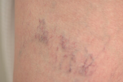 laser spider vein removal before and after pictures