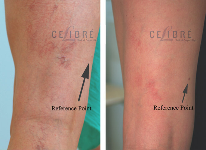 Spider Vein Removal