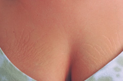 laser stretch mark removal orange county before photo