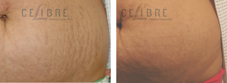 stretch marks Treatmetn before and after