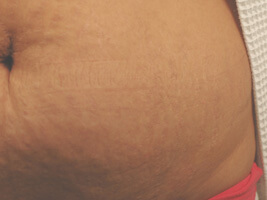 los angeles laser stretch mark removal after picture