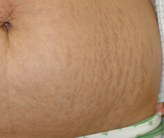 los angeles laser stretch mark removal before picture