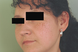 age spot removal los angeles before and after laser pictures
